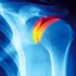 Все, что нужно знать об артрите плечевого сустава