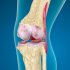 Что такое пателлофеморальный артроз коленного сустава?