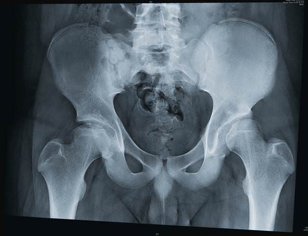 Рентген тазобедренных суставов – цены, норма, расшифровка, подготовка, противопоказания