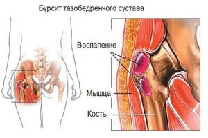 Боли в костях бедер Боли в костях бедер