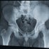 Рентген тазобедренного сустава – универсальный метод диагностики!