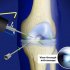 Артроскопическая операция на коленном суставе