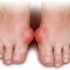 Симптомы и эффективное лечение артроза пальцев ног