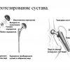 Подробное объяснение процедуры эндопротезирования тазобедренного сустава