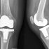 Способы и методики, применяемые при лечении артроза коленного сустава