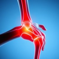Артрит: виды, симптомы и эффективные методы лечения