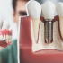 Протезирование зубов: современные технологии и методы