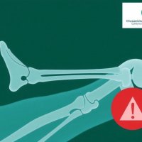 Как избежать осложнений после вывиха сустава: практичный путь к безопасному восстановлению