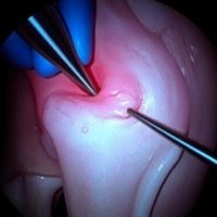 Артроскопический шов мениска