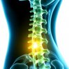Остеохондроз и грыжа диска: когда нужна консультация нейрохирурга?
