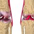 Медикаментозное лечение и советы о том, как лечить артроз коленного сустава