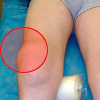 Гигрома коленного сустава и ее симптомы, причины возникновения и лечение