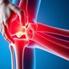 Дегенеративные изменения суставов: можно ли их остановить?