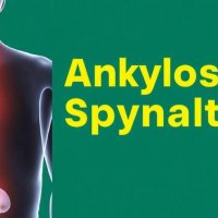Как распознать анкилозирующий спондилит по симптомам: на что обратить внимание прежде, чем ставят диагноз