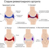 Голос осип: что это и как с этим бороться?