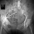 Варианты лечения коксартроза тазобедренного сустава 3 степени без операции