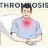 Тромбоз: причины и факторы риска