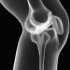 Артрит коленного сустава: симптомы и лечение