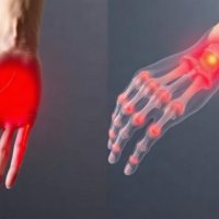 Упражнения для кистей рук при артрозе мелких суставов