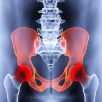 Симптомы остеопороза тазобедренного сустава и его лечение