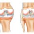 Деформирующий остеоартроз коленного сустава