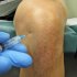 Уколы в коленный сустав при артрозе, препараты и их особенности