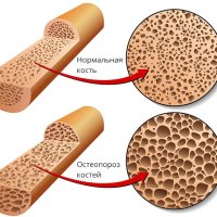 Что такое остеопороз, почему возникает и как развивается болезнь?