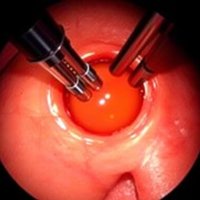 Артроскопический шов мениска