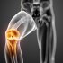 Как диагностировать и чем лечить перелом мыщелка бедренной кости?
