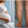 Варикозное расширение вен при беременности: возможные причины, симптомы и способы профилактики