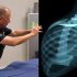 Реабилитация после тотального эндопротезирования плечевого сустава: как вернуть движение без лишних рисков