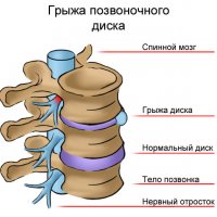 Отказ от прививки от гриппа в школе: образец заполнения