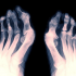 Артрит стопы как признак воспалительного процесса в организме
