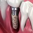 Одномоментная имплантация: идеальное решение для замены зубов