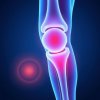 Бурсит коленного сустава: причины возникновения и способы лечения