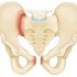 Какими симптомами сопровождается перелом седалищной кости таза, и как он лечится?