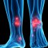 Артрит и инфекции: как постстрептококковый артрит меняет взгляд на воспаление суставов