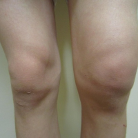 Причины скопления жидкости в коленном суставе и методы ее устранения