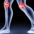 Степени и виды воспаления коленного сустава и методы их лечения