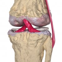 Остеоартроз коленного сустава — симптомы и лечение