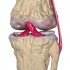 Остеоартроз коленного сустава – симптомы и лечение