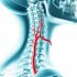 Шея под давлением: остеохондроз и синдром позвоночной артерии от боли до головокружения