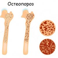 Как возникает, развивается и лечится остеопороз?