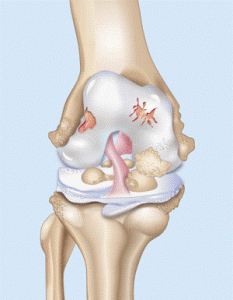 Степени гонартроза коленного сустава