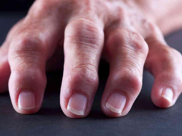 Фото артрита пальцев рук