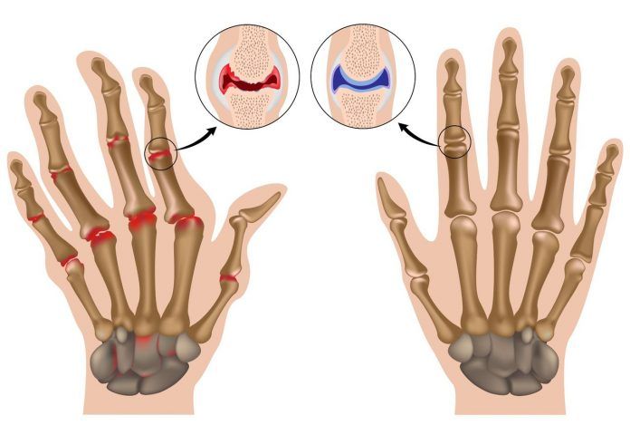 Здоровые пальцы и с артритом