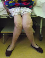 Болезни коленного сустава