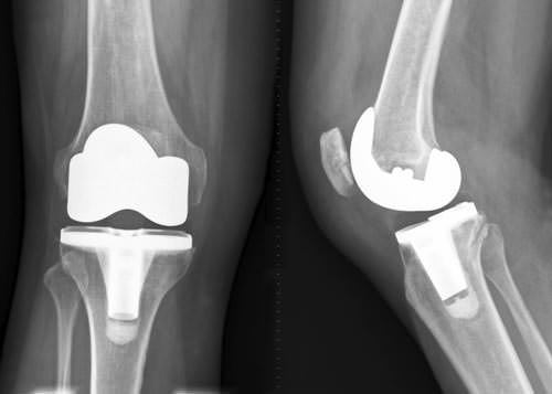 Имплант коленного сустава на рентгене