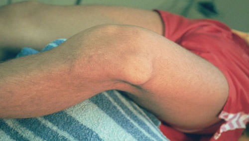 Артралгия коленного сустава: симптомы и лечение