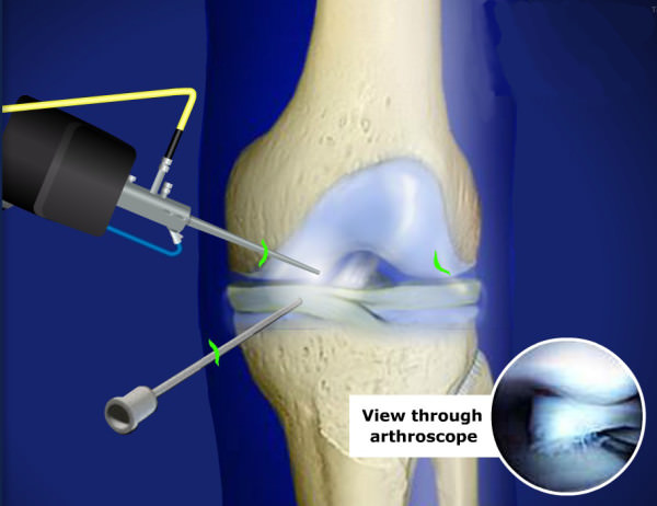 Артроскопическая операция на коленном суставе